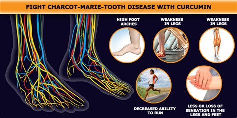 Charcot Neurological Triad / Charcot foot / He is best known today for ...