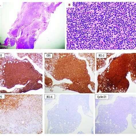 Bone marrow biopsy. Bone marrow biopsy (H&E) is markedly hypercellular ...