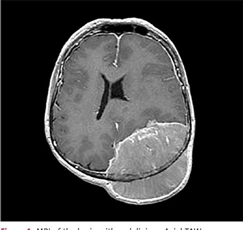 Figure From Anaplastic Meningioma Presenting As A Left Parietal Mass