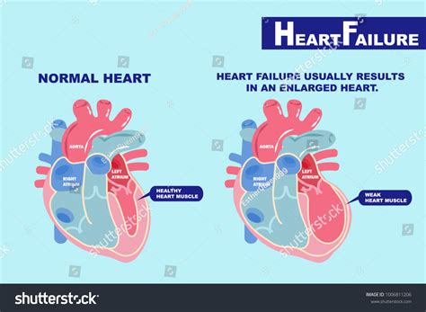 Cartoon Heart Failure Concept On Green Stock Vector (Royalty Free ...