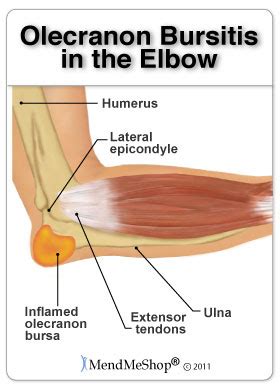 Elbow Bursitis