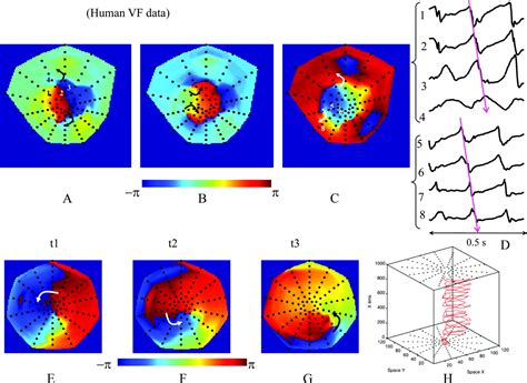 Phase Mapping Of Cardiac Fibrillation Circulation Arrhythmia And Electrophysiology