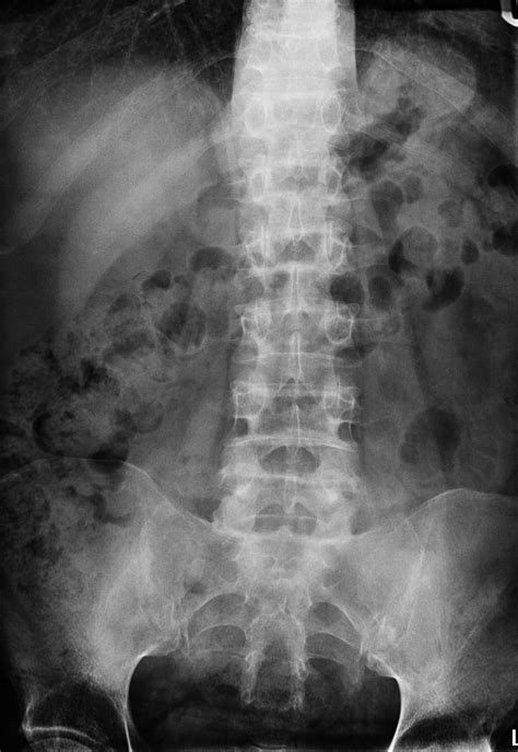 Severe Osteoporosis X Ray