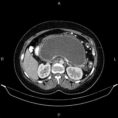 Walled Off Pancreatic Necrosis