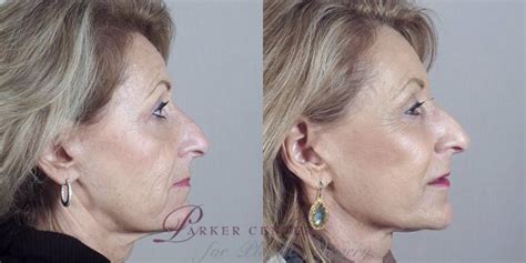 Facelift Before And After Pictures Case 36 Paramus New Jersey Parker Center For Plastic Surgery