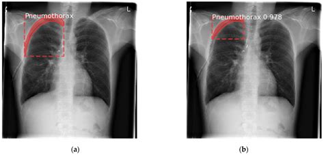 Hemopneumothorax X Ray