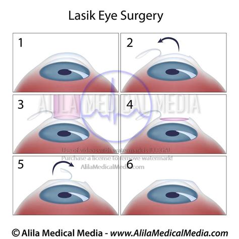 Alila Medical Media Lasik Eye Surgery Procedure Medical Illustration