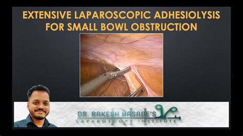 Extensive Laparoscopic Adhesiolysis For Small Bowel Obstruction