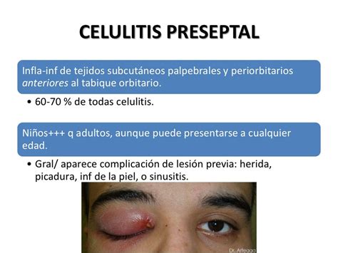 Celulitis Orbitaria Y Periorbitaria