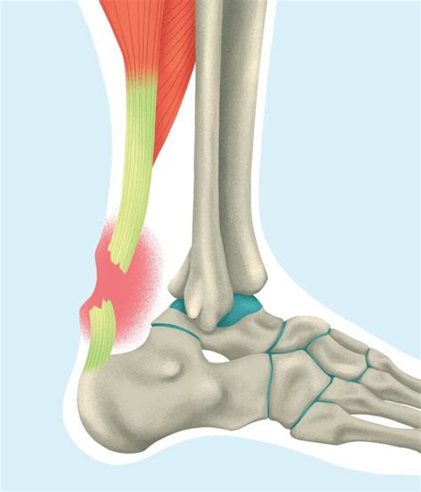Rupture Du Tendon D Achille Causes Et Traitements Orliman