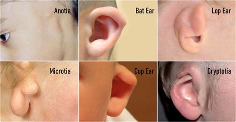 What Causes Malformed Ears