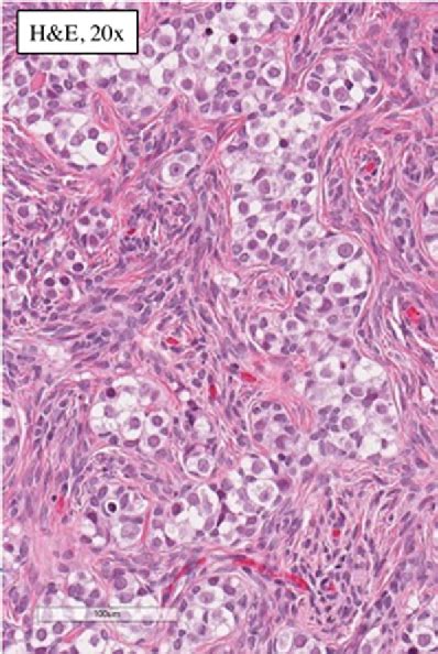 Figure 1 From Early Bilateral Gonadoblastoma In A Patient With Mixed