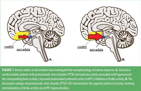 Depersonalization Disorder: What Is It, Diagnosis, And More, 42% OFF