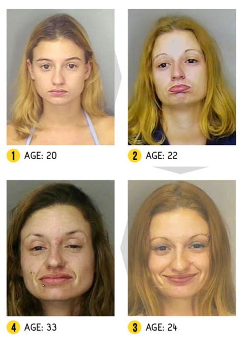 Harrowing Pictures Show The Devastating Effects Of Using Crystal Meth