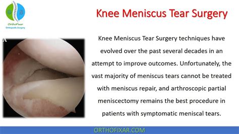 Knee Meniscus Tear Surgery : r/orthofixar