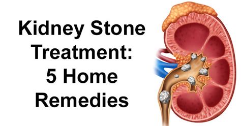 Kidney Stone Treatment: 5 Home Remedies - DavidWolfe.com