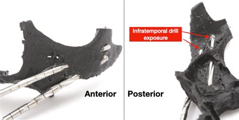 Zygoma Fracture During Zygomatic Implant Installation