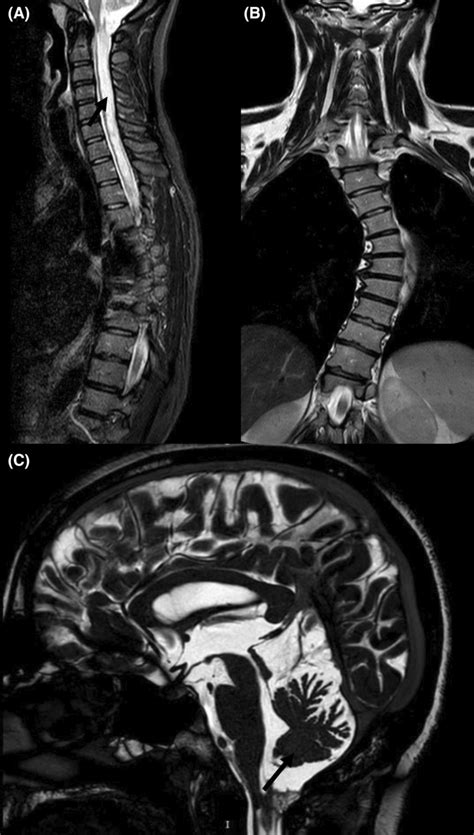 Sagittal T2‐weighted Mri Of The Cervicothoracic Spine Demonstrating A