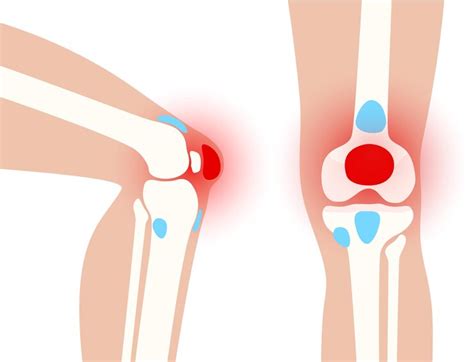 Premium Vector Bursitis Inflammation Concept