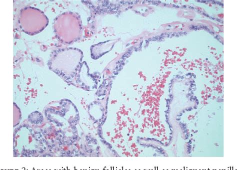 Figure 1 From A Case Of Papillary Thyroid Carcinoma In Struma Ovarii