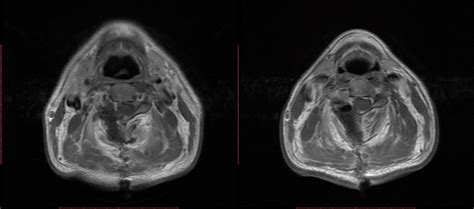 Postoperative Mri Showed Complete Resection Of The Tumor Download