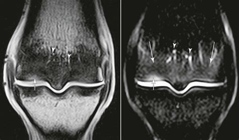 Magnetic Resonance Imaging of the Fetlock Joint | Veterian Key