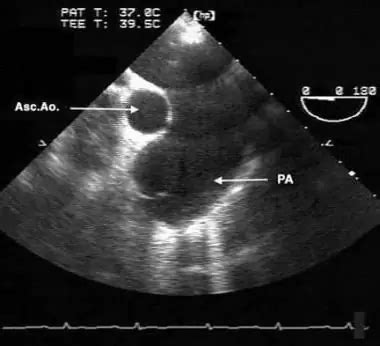 Eisenmenger syndrome: causes, symptoms, diagnosis, treatment | Health 2025