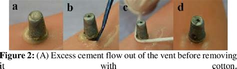 Figure From Retained Excess Resin Cement Around Tissue Level Implants