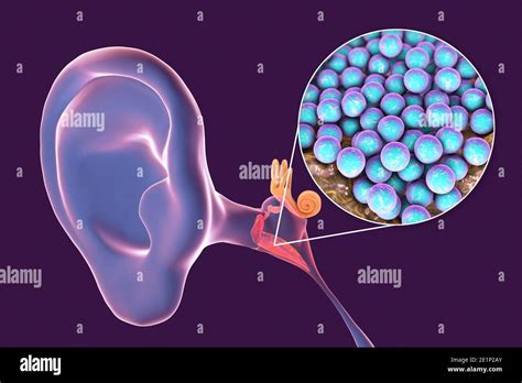 Otitis Media Ear Infection Illustration Stock Photo Alamy