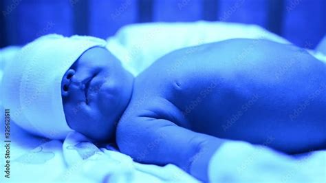 newborn   treatment  jaundice  ultraviolet light baby