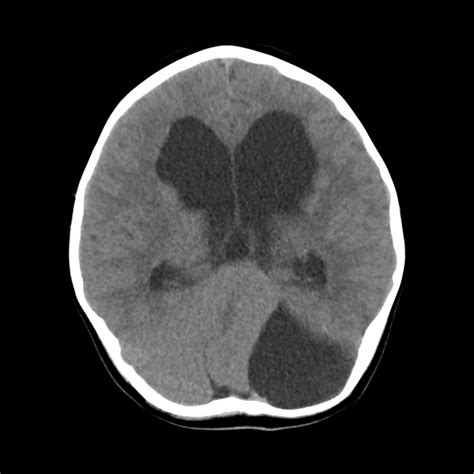 Pediatric Arachnoid Cyst of Posterior Fossa | Pediatric Radiology ...