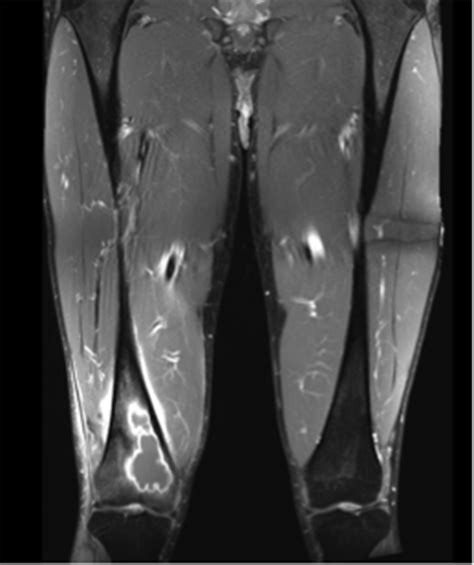 Vastus Medialis Oblique Mri