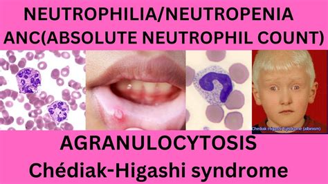 NEUTROPHILS,ABOSOLUTE NEUTROPHIL COUNT(ANC),NEUTROPHILA,NEUTROPENIA,AGRANULOCYTOSIS,TOXIC ...