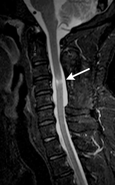 Diagnostic Approach To Intrinsic Abnormality Of Spinal Cord Signal