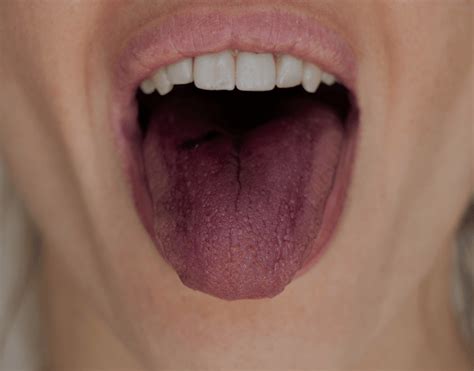 Purple Tongue Causes And Treatment Options Natrusmile