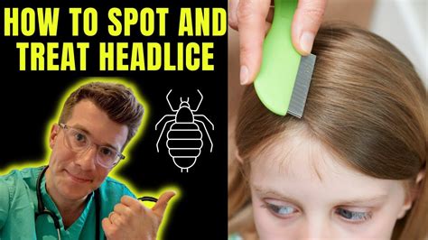 How To Spot And Treat Head Lice Nits Doctor Odonovan Explains