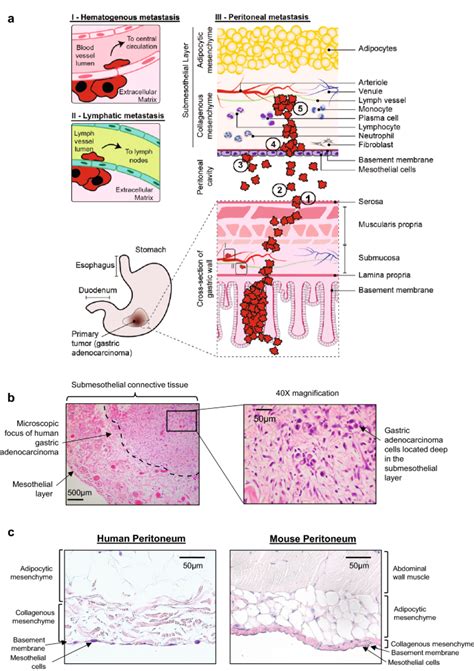 Investigating The Mechanisms Of Peritoneal Metastasis In Gastric