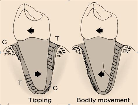 Types Of Tooth Movement