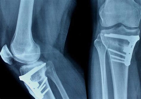 Knee Preservation - Osteotomy Surgery Mumbai | Dr. Jay Shah