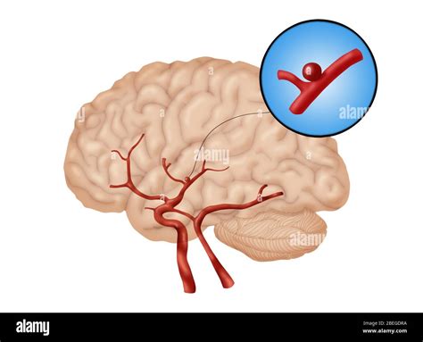 Brain Aneurysm 1 Of 3 Stock Photo Alamy