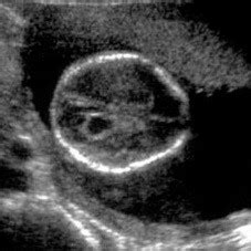 Soft Markers Fetal Ultrasound