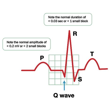 ECG Waves - Visualmed