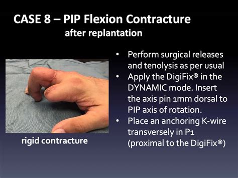 CASE 8: PIP Flexion Contracture after Replantation - Virak Orthopedics