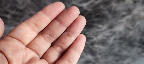 Close Up Of Clavus Or Corn On Finger Dermatology Problem Stock Photo