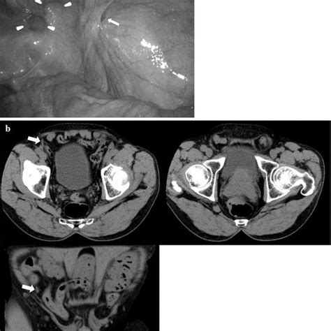 Diagnosis Of Inguinal Hernia By Prone Vs Supine Position Computed