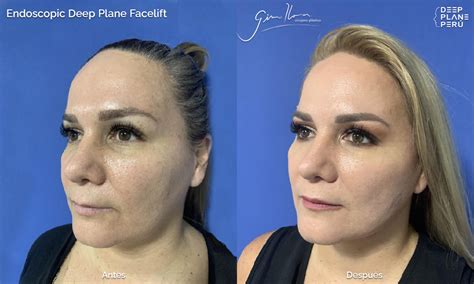 Pre Y Post Endoscopic Deep Plane Facelift Caso Lifting Facial De