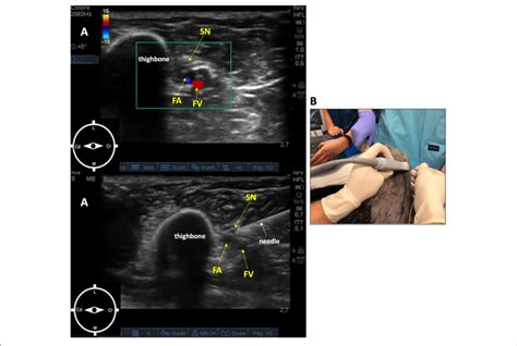 Saphenous Nerve Block Ultrasound