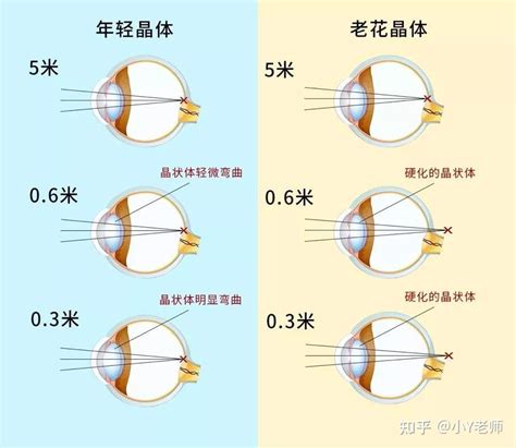 近视眼的人老了也会老花吗？ 知乎