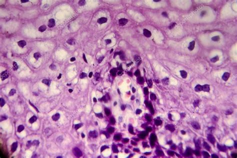 C Ncer De Cuello Uterino Micrograf A Ligera De Biopsia Cervical Foto