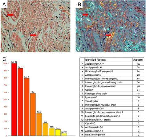 Amyloidosis of the tongue: a rare case report | Brazilian Journal of Otorhinolaryngology